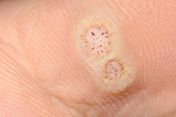 Plantar warts caused by the human papillomavirus, or HPV, on an infected foot