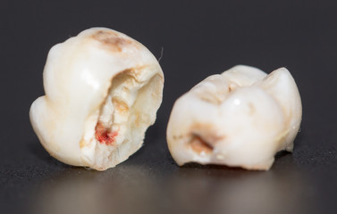 tooth decayed caries on a black background