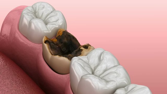 Periostitis tooth - Lump on Gum Above Tooth. Medically accurate dental 3D animation