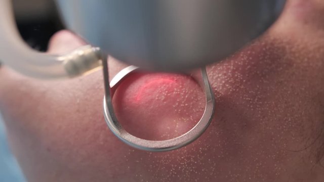 Extreme Close-Up Shot. A young woman having laser skin treatment/laser resurfacing/laser facial peeling with Co2 laser in a cosmetology/plastic surgery clinic.