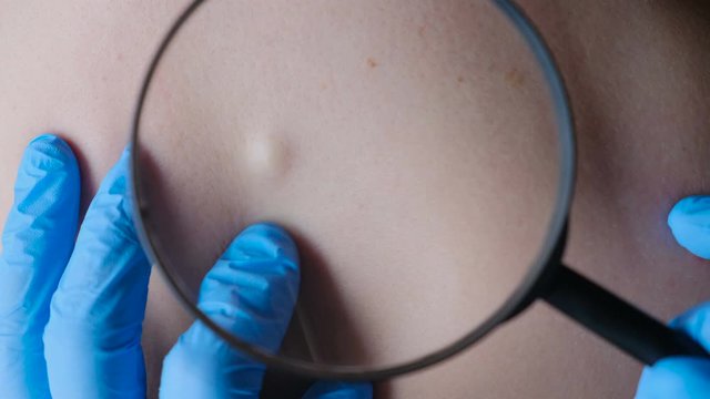 The doctor shows a lipoma, wen or other benign mass on the patient&rsquo;s skin.