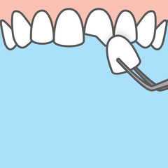 Blank banner Upper Veneer tooth illustration vector on blue background. Dental concept.