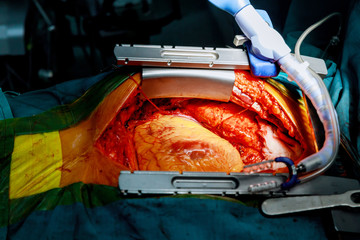 Heart surgery. Open heart surgery suture greater saphenous vein