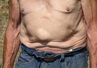 Stomach Hernia after operation.