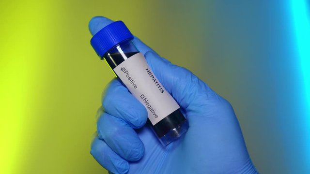 Positive Blood Test Tube Hepatitis Virus Infection Outbreak Epidemic