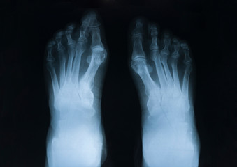 X-ray of feet with rheumatoid arthritis disease