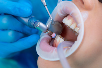 Close-up of a tooth drill with a head for polishing and brushing teeth. Professional oral hygiene