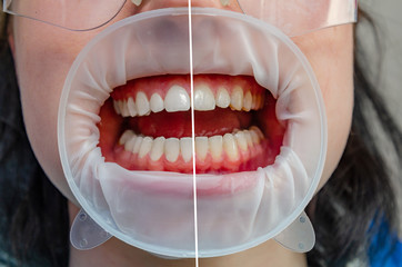 Teeth in the mouth at the dental clinic, the mouth is opened with a cheek retractor.