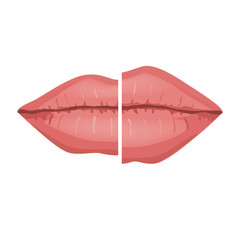 Female Lips Before and after Filler Injections, Vector Infographic illustration. Beautiful and Sexy Perfect Lips Isolated on White background