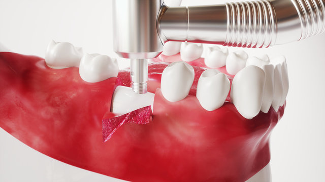Tooth implantation picture series 5 of 13 - 3D Rendering