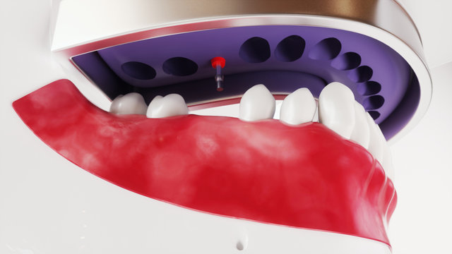 Tooth implantation picture series 10 of 13 - 3D Rendering