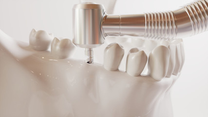 Fototapeta na wymiar Tooth implantation picture series V02 - 2 of 8 - 3D Rendering