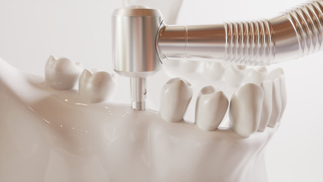 Tooth implantation picture series V02 - 3 of 8 - 3D Rendering