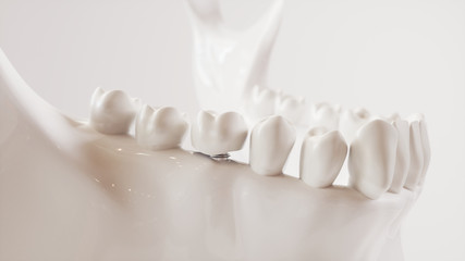 Tooth implantation picture series V02 - 8 of 8 - 3D Rendering