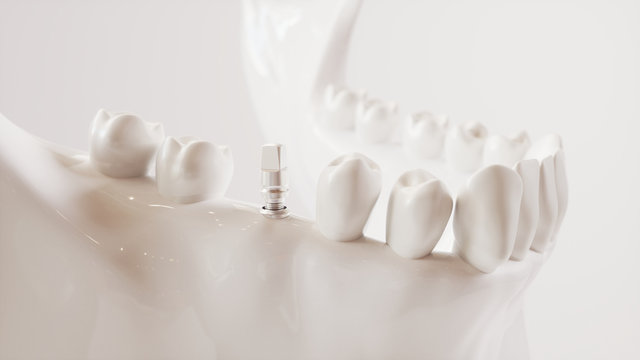 Tooth implantation picture series V02 - 7 of 8 - 3D Rendering