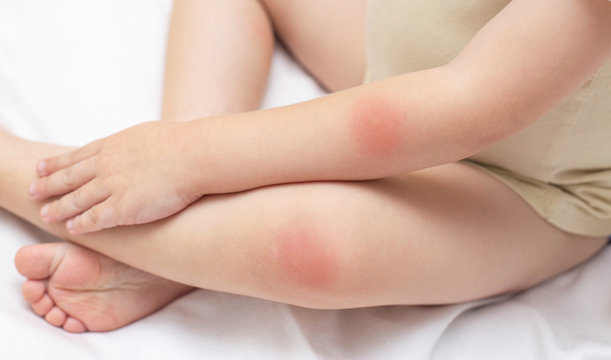 Hands and feet of a young child who has a rash and redness on the skin. The concept of treatment of diseases and skin care in children, background. Dermatology