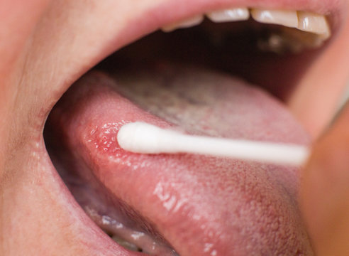 Taking a smear for a disease in the tongue of a woman. Glossitis and gingivitis tongue disease research concept, medical