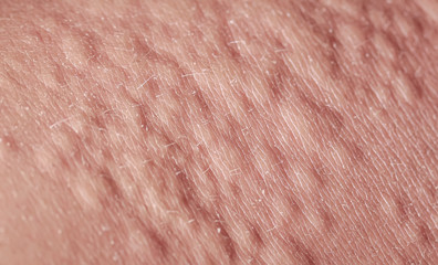 Fototapeta premium unhealthy irritated texture human skin covered with allergic blisters and blisters