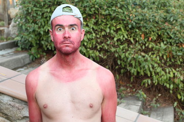Sunburned young man with extreme tan lines 