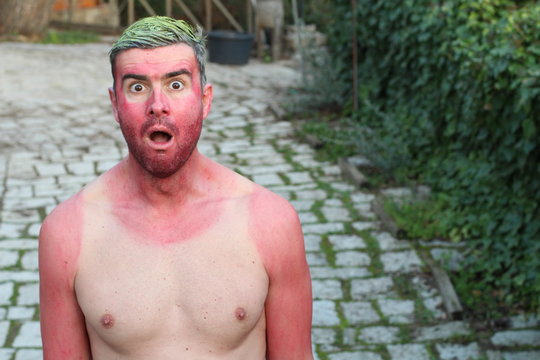 Sunburned Young Man With Extreme Tan Lines 