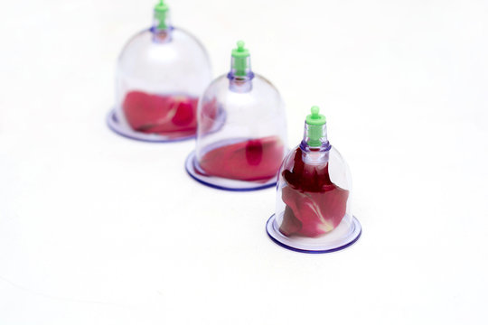 Vacuum therapy Oriental medicine. Hidjama