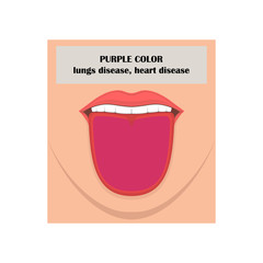 Lower face, open mouth, tongue. The inscription PURPLE COLOR, lungs disease, heart disease. Vector illustration.