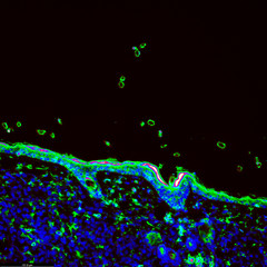 Tumour immunofluorescence IHC image of immunotherapy treatment. Tumor cells in blue attacked by immune system T cells lymphocytes in green - 320665937