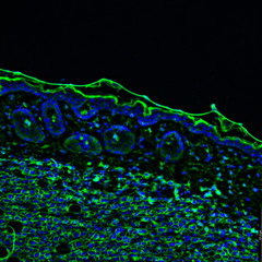Tumour immunofluorescence IHC image. Aggressive metastatic Melanoma Tumor cells in green with blue nuclei invading into the skin. - 320665972