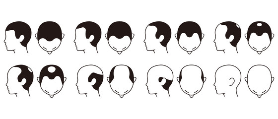 ハミルトン・ノーウッド分類　ハゲ