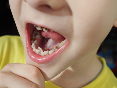 Abnormal boy tooth. The extra narrow strange tooth grew in the boy's mouth. Boy shows his crooked tooth. Patient Orthodontist. Children's teeth problems