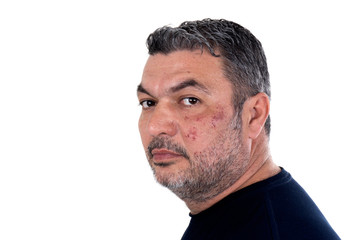 portrait of mature man with injured face