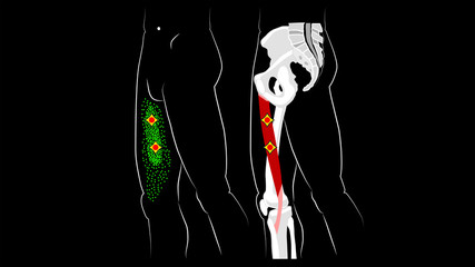 Gracilis muscle. Structure, trigger points, and reflected pain in the thigh muscle