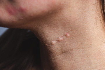 Real skin Biorevitalization. Traces of biorevitalization injections on the neck. Biorevitalization needle marks on the neck