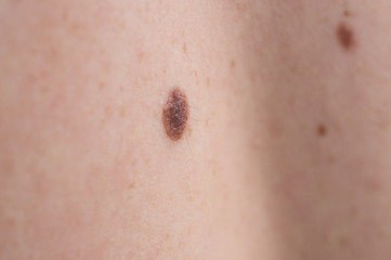 Checking benign moles. Close up detail of the bare skin on a man back with scattered moles and freckles.
