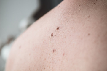 Checking benign moles. Close up detail of the bare skin on a man back with scattered moles and freckles.