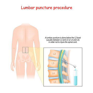 Spinal Tap Procedure. Detailed Diagram Of Lumbar Puncture.