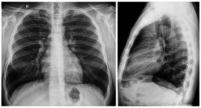 Radiography x-ray film of human chest