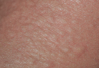 unhealthy irritated human skin texture covered with allergic bumps and pimples