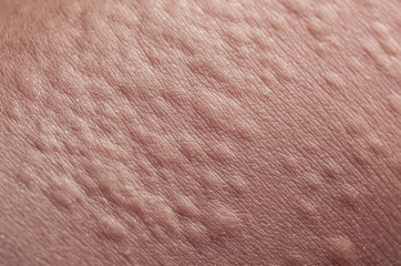 unhealthy irritated human skin texture covered with allergic bumps and blisters