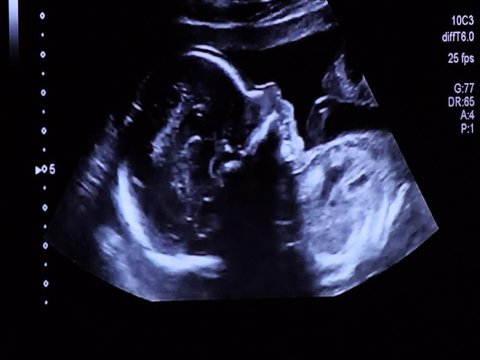 Cute 20 weeks baby fetus face profile during ultrasound examination, measuring head