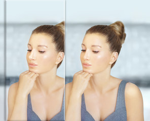 Rhinoplasty.Before and after	