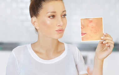 Post-Acne Marks /Treating Acne Scars.Acne Scar Removal	
