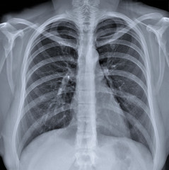 normal radiography of chest organs in direct projection, traumatology and orthopedics,  injury