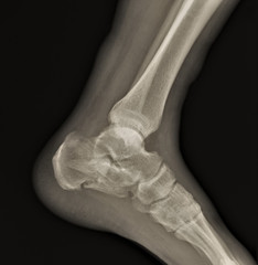 x-ray of the ankle joint with a fractured heel bone