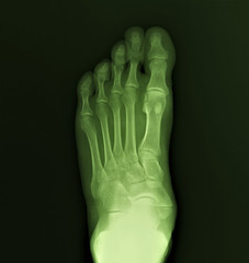 normal radiography of the foot, medical diagnostics, traumatology and orthopedics, rheumatology