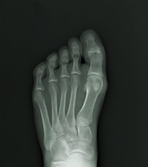 normal radiography of the foot, medical diagnostics, traumatology and orthopedics, rheumatology