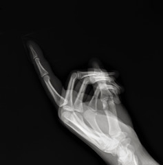 Naklejka premium normal x-ray of the hand bones and fingers