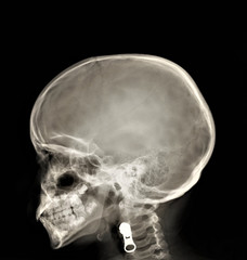 normal x-ray of the skull in lateral projection,medical diagnostics