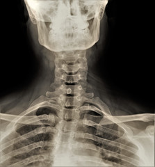 x-ray of the cervical spine