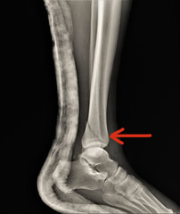 fracture of the lateral ankle on x-ray